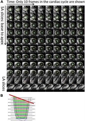 Cardiac MRI assessment of anthracycline-induced cardiotoxicity